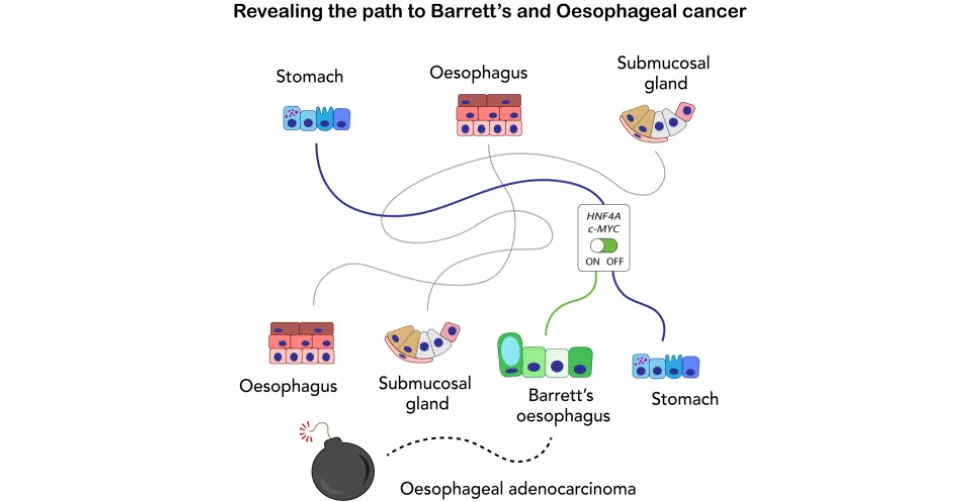 Revealing the path to Barett's and oesophageal cancer