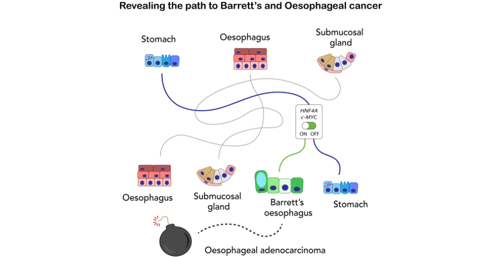 Revealing the path to Barett's and oesophageal cancer